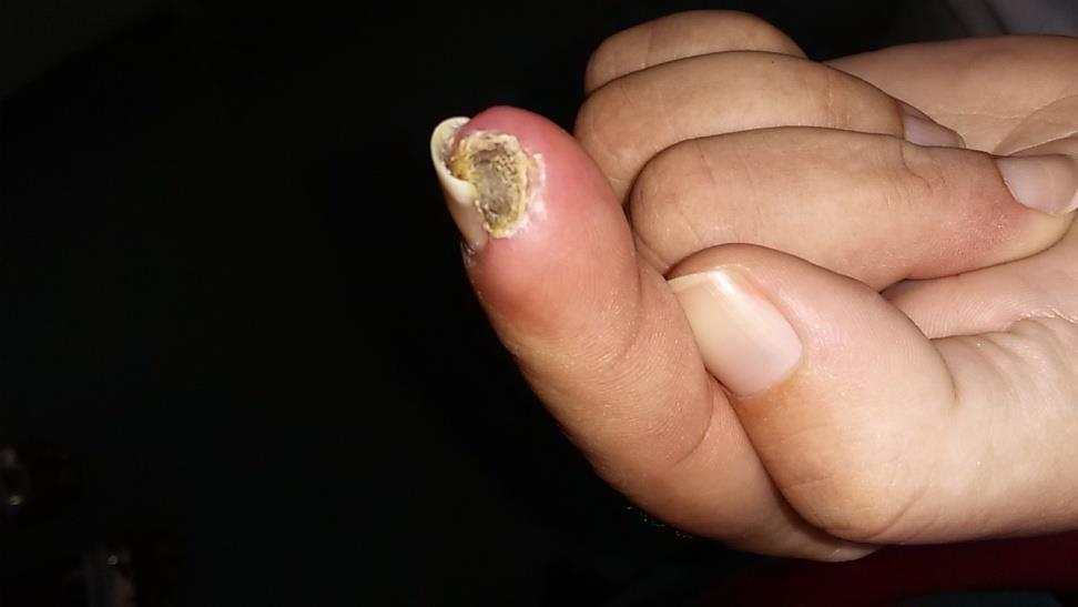 Αναστασία, 37 ετών Ακροκυάνωση, ισχαιμικές νεκρώσεις δακτύλων χεριών από ~30