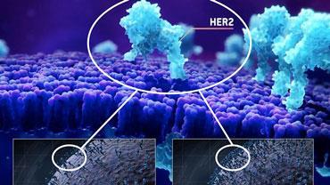 CT-P6 study Ontruzant CT-P6 compared with reference trastuzumab for HER2-positive breast cancer: a randomised, double-blind,