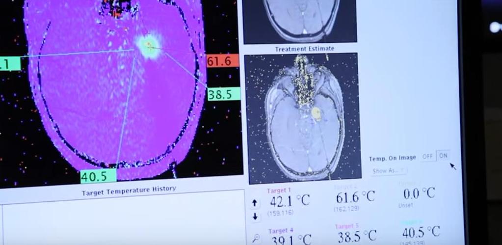 Φυσικός Noσοκομείων και Θεραπεία με laser Department of Neurosurgery Boston Children s Hospital Κατάλυση