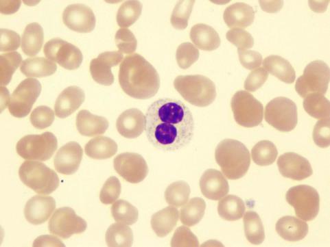 Μυελοδυσπλαστικά Σύνδρομα - Διάγνωση Αίμα Κυτταροπενίες Μορφολογικές ανωμαλίες Αναιμία ορθόχρωμη ορθοκυτταρική