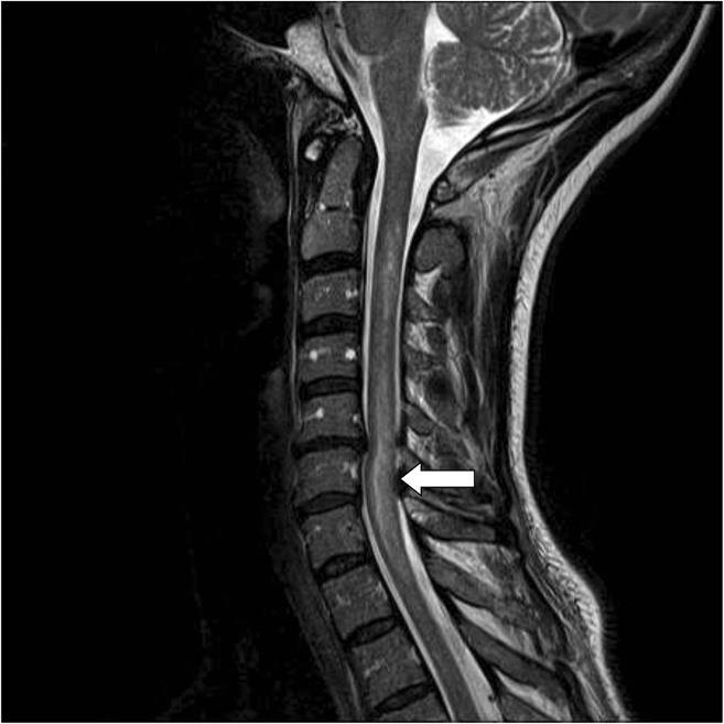 MRI T2 weighted sequence of the cervical MRI showing abnormal signal changes