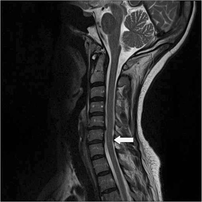 MRI T2 weighted sequence of the cervical MRI after Prednisone, Cyclophosphamide and