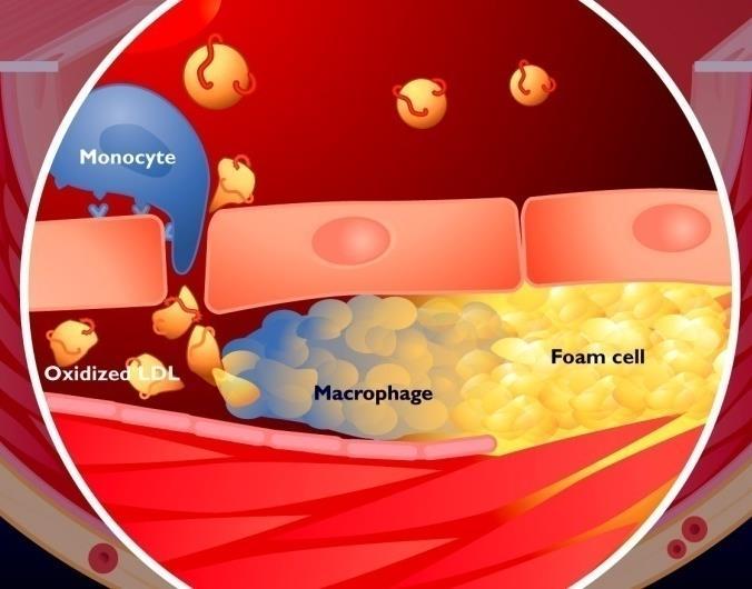 Παθογένεια της αθηροσκλήρωσης