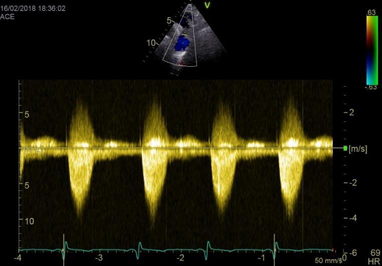 Περιορισμοί στην χρήση Doppler H εξίσωση Bernouli είναι