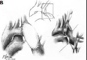 native CoA Resection and simple end-to-end anastomosis