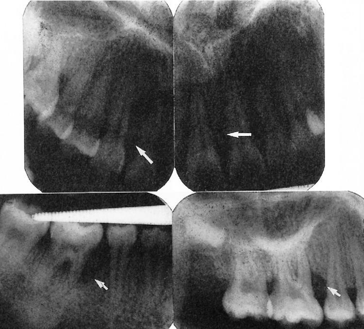 Νοσήματα περιοδοντίου Άλλα είδη περιοδοντικής νόσου Aggressive (επιθετική) periodontitis (πρώην εφηβική περιοδοντίτιδα) Εντοπισμένη ή γενικευμένη (localized and generalized) ΘΕΡΑΠΕΙΑ Radiographic