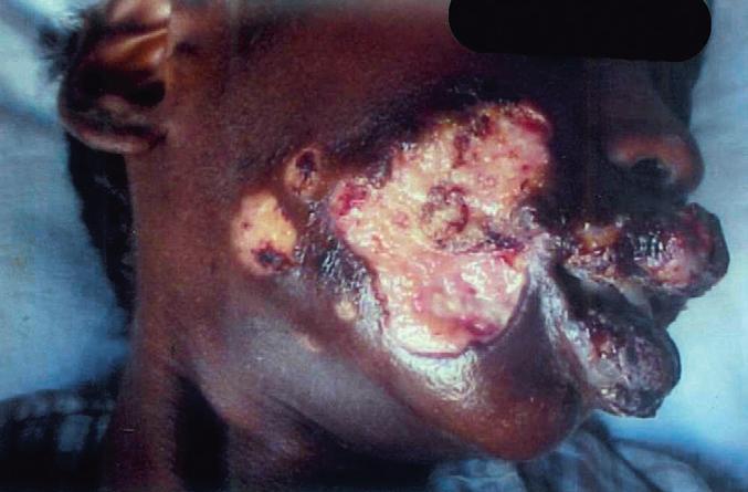 sub- Saharan Africa), πολύ σοβαρή ANUG επίσης ως «gangrenous stomatitis» Κλινική εικόνα Παιδί < 10 ετών με κακή διατροφή