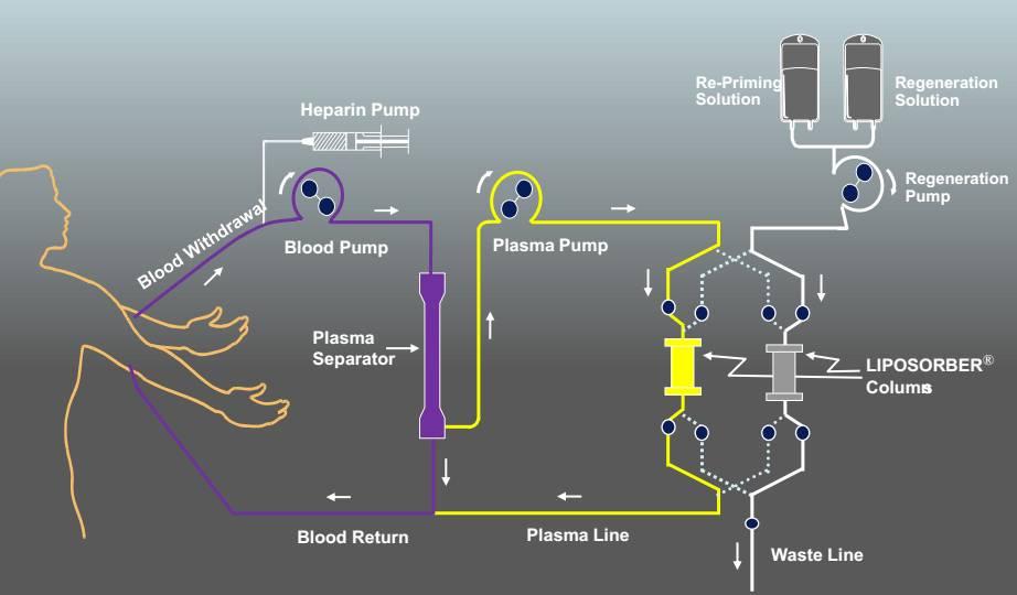 LDL-Apheresis ΜΕ ΔΙΑΧΩΡΙΣΜΟ ΠΛΑΣΜΑΤΟΣ cellulose beads impregnated with Dextran Sulfate