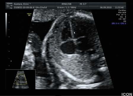 Υπερηχογράφημα Γ επιπέδου ( καρδιάς εμβρύου) Το υπερηχογράφημα καρδιάς εμβρύου είναι μια διαγνωστική εξέταση που γίνεται στις 20-22 εβδομάδες