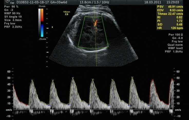 Υπερηχογράφημα ανάπτυξης- έλεγχος Doppler Το υπερηχογράφημα ανάπτυξης γίνεται συνήθως μεταξύ 32-34 εβδομάδων κύησης αλλά μπορεί να γίνει και νωρίτερα σε ειδικές περιπτώσεις ( π.