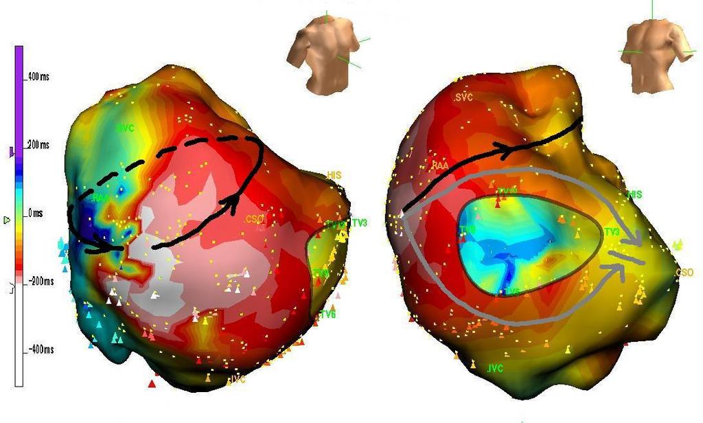 New Technology in AF Ablation 2004 2018 EnSite System EnSite System Plenty