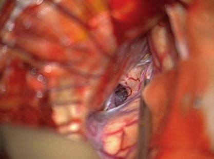 12 Surgery of IC-Anterior Choroidal Aneurysms 97 a b c d e f Fig. 12.4 (a f) Aneurysm clipping.