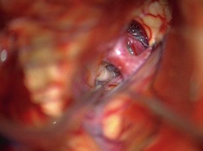 (b) Distal ICA after head has been lowered depicts bifurcation and A1.