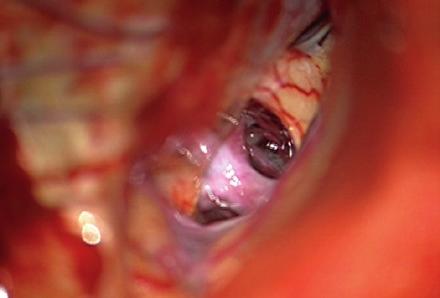 (d) After deflecting the ICA with dissector, AChA can be seen.