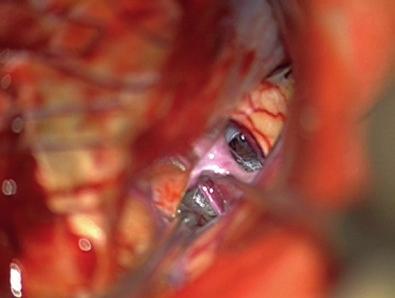 (f) Second smaller clip is needed for neck area to reconstruct beginning of AChA wall The optic