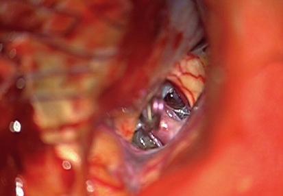 cistern on the lateral side in ruptured cases.