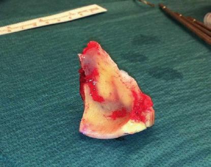 the sphenoid bone.