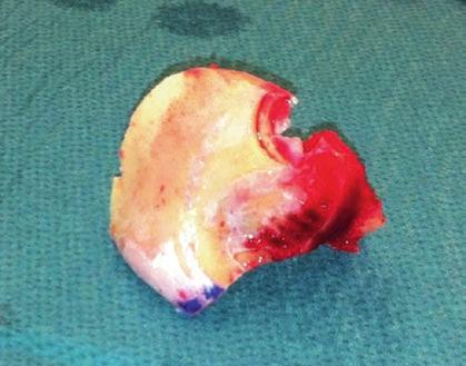 red frontal base line). (b) Shows inner side of the orbital roof.