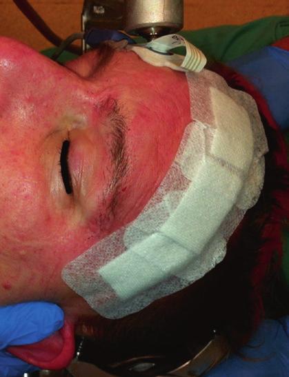 Craniotomy groove and burr hole have been sealed with bone cement, followed by meticulous suture