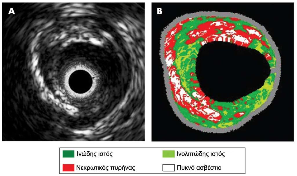 Εικονική Ιστολογία/Virtual Histology H VH αντιστοιχίζει, με βάση έναν χρωματικό