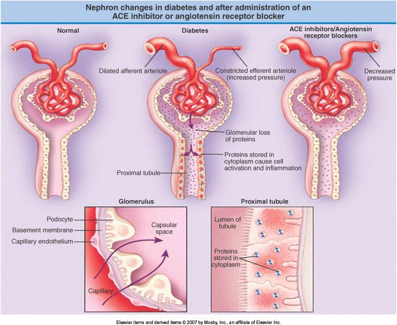 Diabetic Nepropathy: Pathogenesis Ritz E. Pathogenesis, Clinical Manifestations and Natural History of Diabetic Nephropathy.