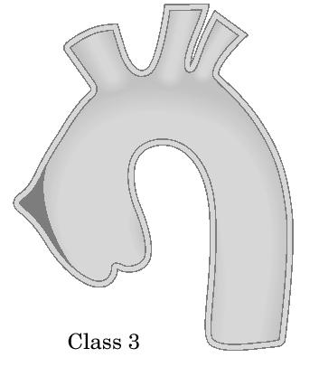 Incomplete Dissection or subtle or discrete (class III) Laceration of intima & part of the media BUT separation of medial layers is not so large after the acute phase the bare area is covered with