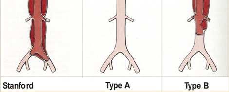 60% 10-15% 25-30% Ascending aorta +/-