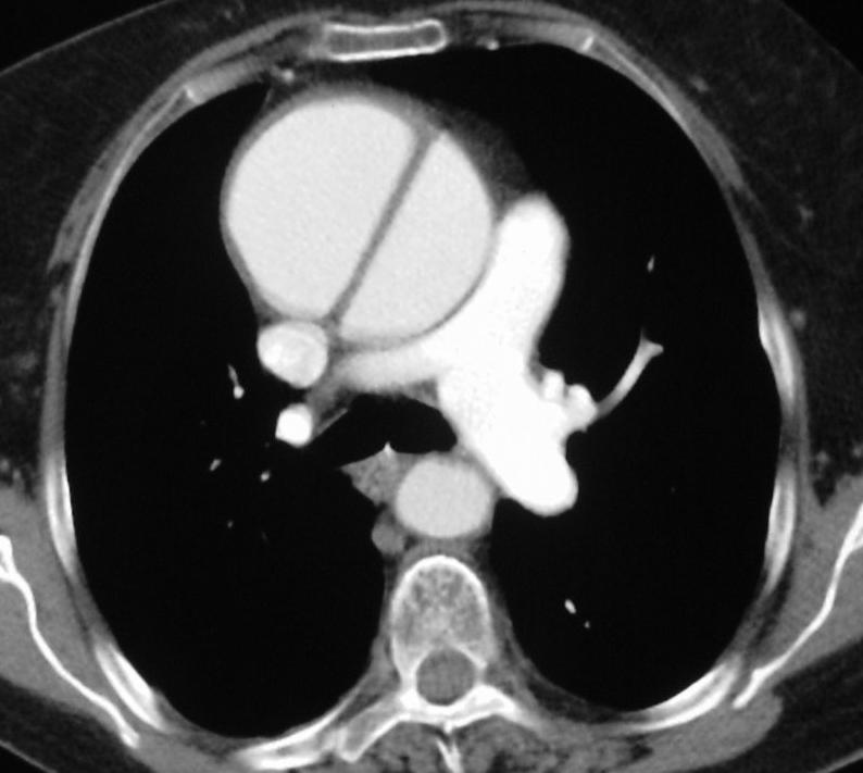 Distal AAS Descending aorta mortality: 10% medical txvs30% surgery