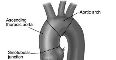 Acute Aortic Syndromes (AAS): the aortic catastrophe AAS new term for an old disease 1760: 1 st case report (King George