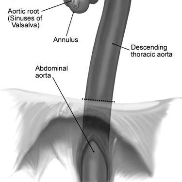 / acute chest pain syndromes aortic emergencies To include the diverse aortic pathology (> dissection) Update was needed