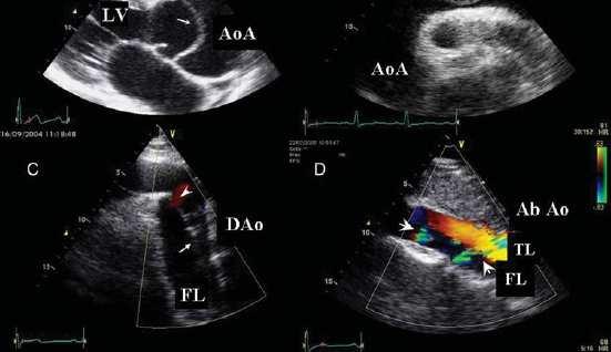 AAS -role of TTE Echocardiography in aortic disease: EAE