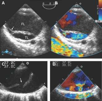 Classic AoD Evolution Longitudinal progression (back in the true lumen) Partial / total thrombosis of the FL (if no re-entrance) - especially early Early rupture of the
