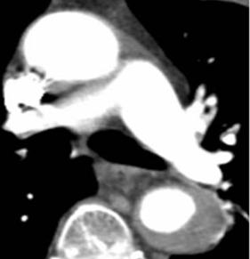 IMH or intra-aortic hematoma