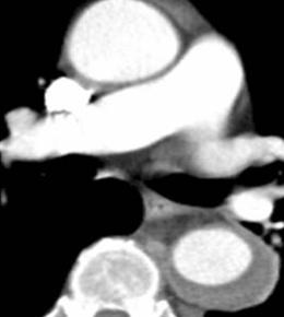 unpredictable Aortic rupture