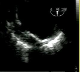 PAU (class IV) Evolution: unknown Slow progression