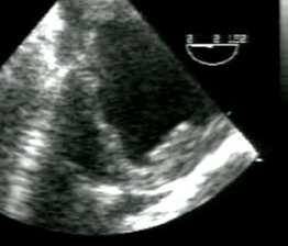 Complete rupture (more often than AoD) AoDvia the