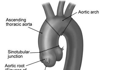 Acute Aortic Syndromes (AAS) the basics of the
