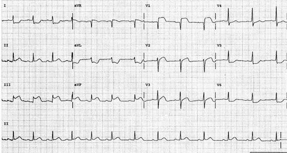 AAS diagnostic assessment (III): ECG Normal 30% Non specific abnormalities common ST-T