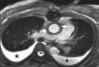 AAS aortic imaging -MRI Many Advantages Gold standard 3D reconstruction High resolution