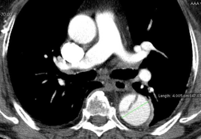 (absent or not seen) Dx with CT/TOE/MRI aortic