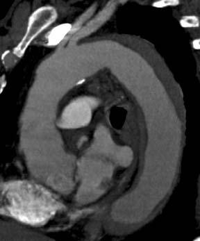 IMH or intra-aortic hematoma