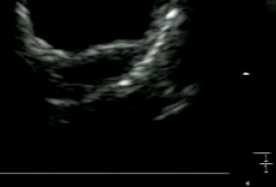 Dx with CT/TOE/MRI No flow within