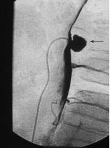 ATHEROMATOUSlesion -penetrates the