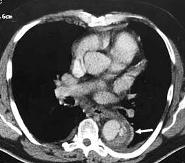 DESCENDINGaorta (may be >1) Degree of