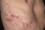 Δέρμα/αισθητικά νεύρα Έρπης Ζωστήρ Αναζωοπύρωση του ιού του έρπηταανεμευλογιάς Ανοσοκατασταλμένοι ασθενείς σε κίνδυνο Οξύ άλγος Υπεραισθησία