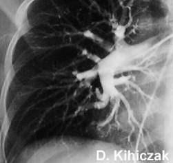 Πνευμονική Αγγειογραφία Westermark sign Dilatation of pulmonary vessels