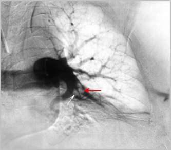 Pulmonary