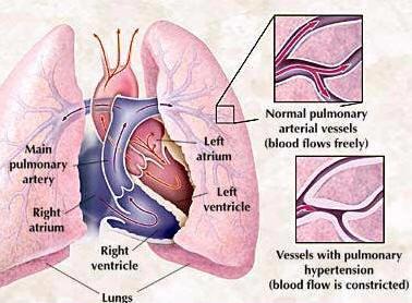 Πνευμονική υπέρταση/ Πνευμονική καρδία Συχνά συνυπάρχει ΧΑΠ Κολλαγόνωση Χρόνια θρομβοεμβολική νόσος Σπάνια πρωτοπαθής