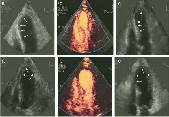 Pre PCI