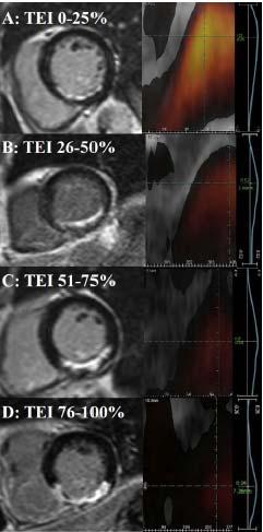 Bedside Assessment of Myocardial Viability UsingTransmural Strain Profile in Patients With ST ElevationMyocardial